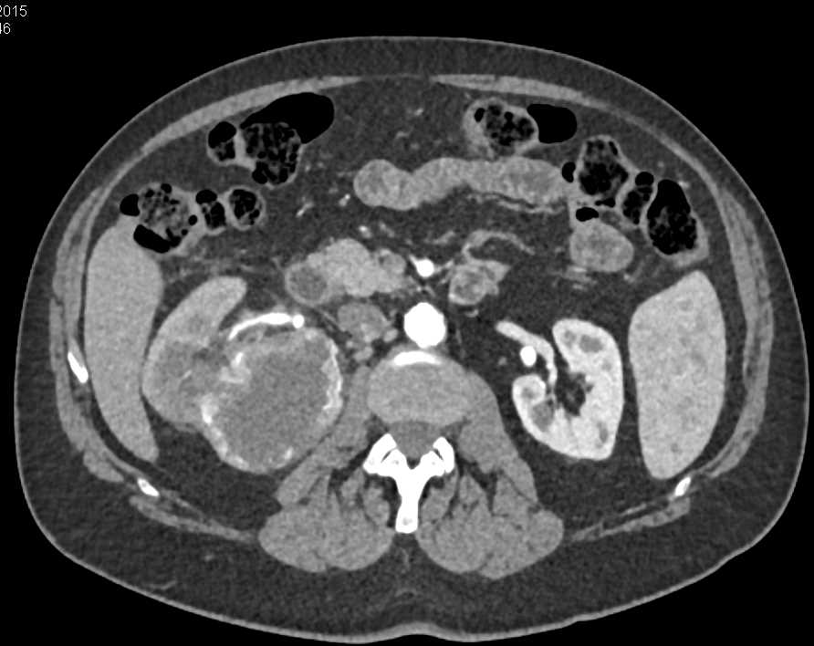 Clear Cell Renal Cell Carcinoma - CTisus CT Scan