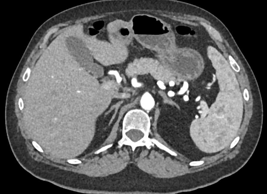 Clear Cell Renal Cell Carcinoma - CTisus CT Scan