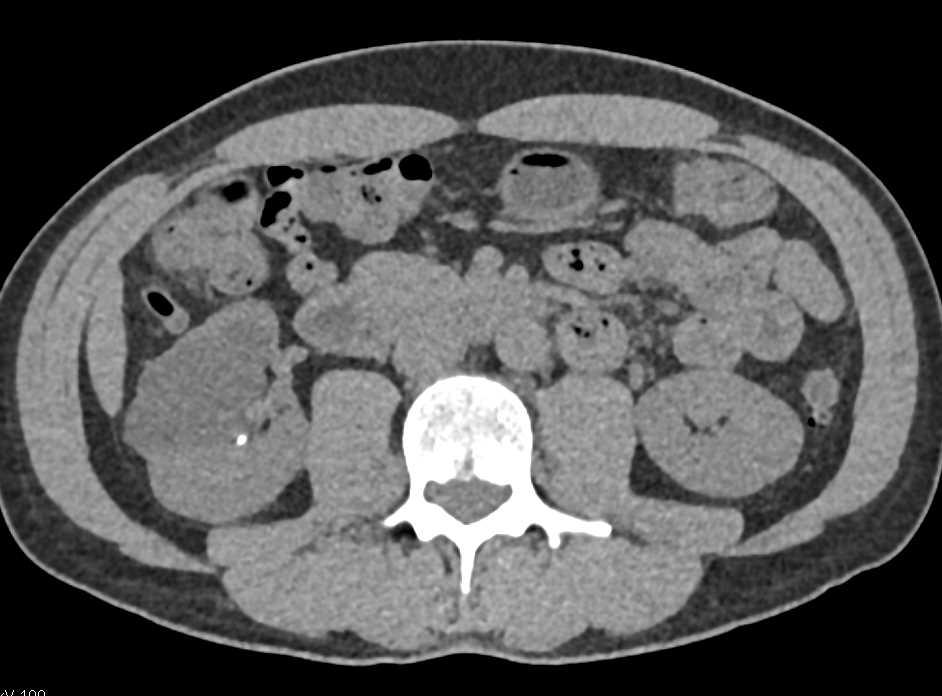 Bosniak 2F Cyst Right Kidney - CTisus CT Scan