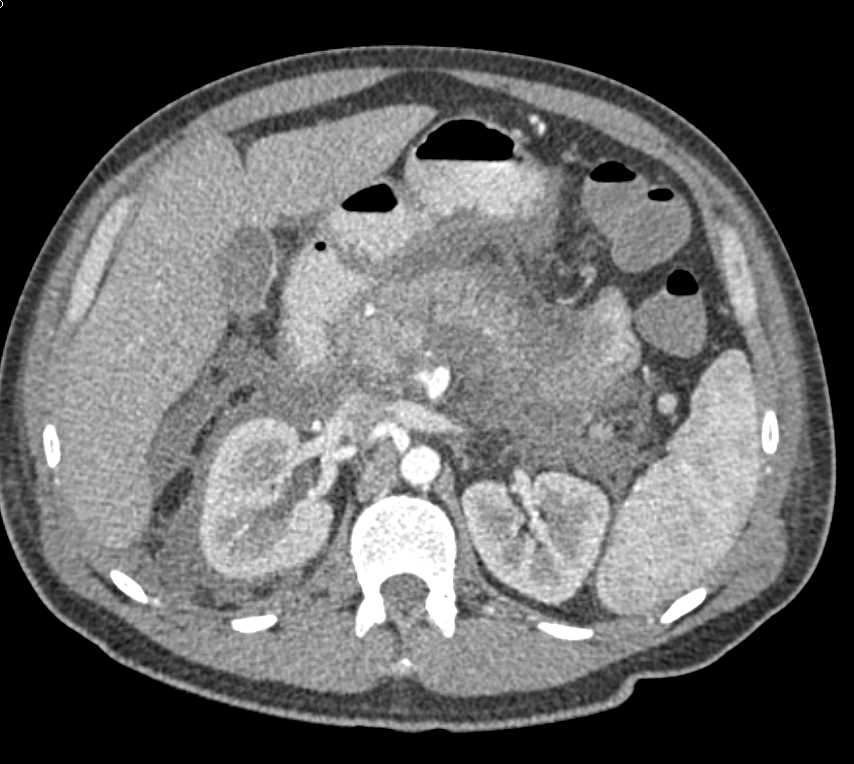 Lymphoma with Extensive Adenopathy and Infiltration of the Right Kidney - CTisus CT Scan