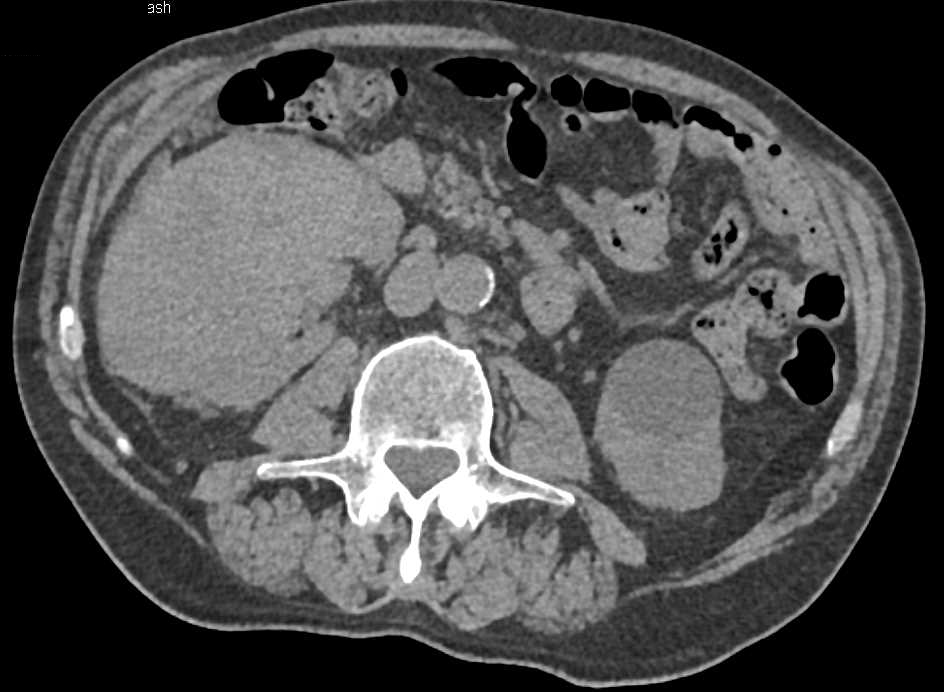 Clear Cell Renal Cell Carcinoma (RCC) with Neovascularity Invades the Renal Vein and Inferior Vena Cava (IVC) - CTisus CT Scan