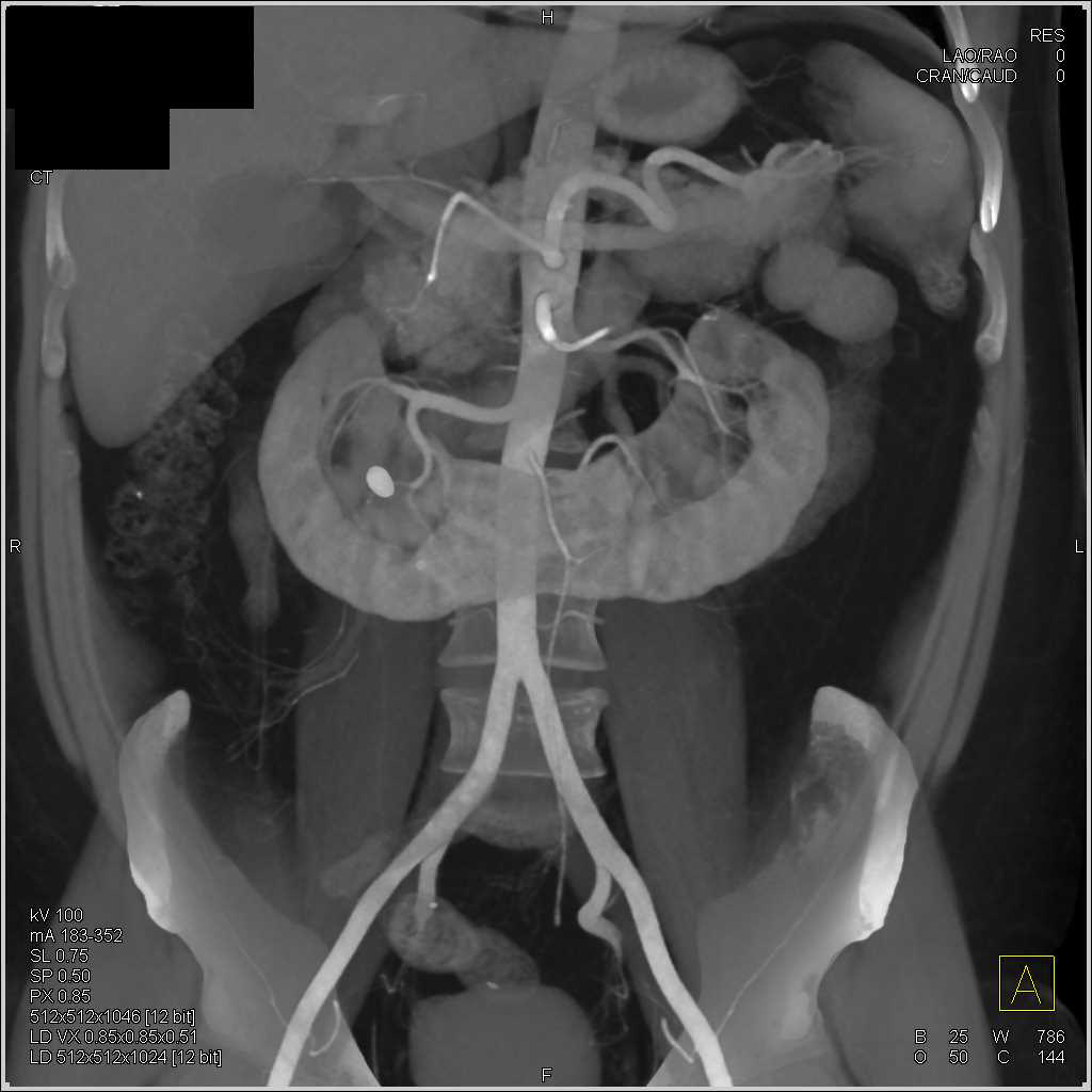 Horseshoe Kidney with Calculus but Normal Function - CTisus CT Scan