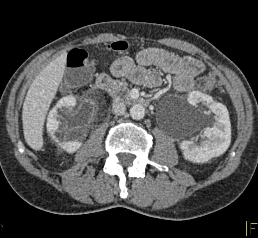 Transitional Cell Cancer (TCC) Right Kidney and Ureter - CTisus CT Scan