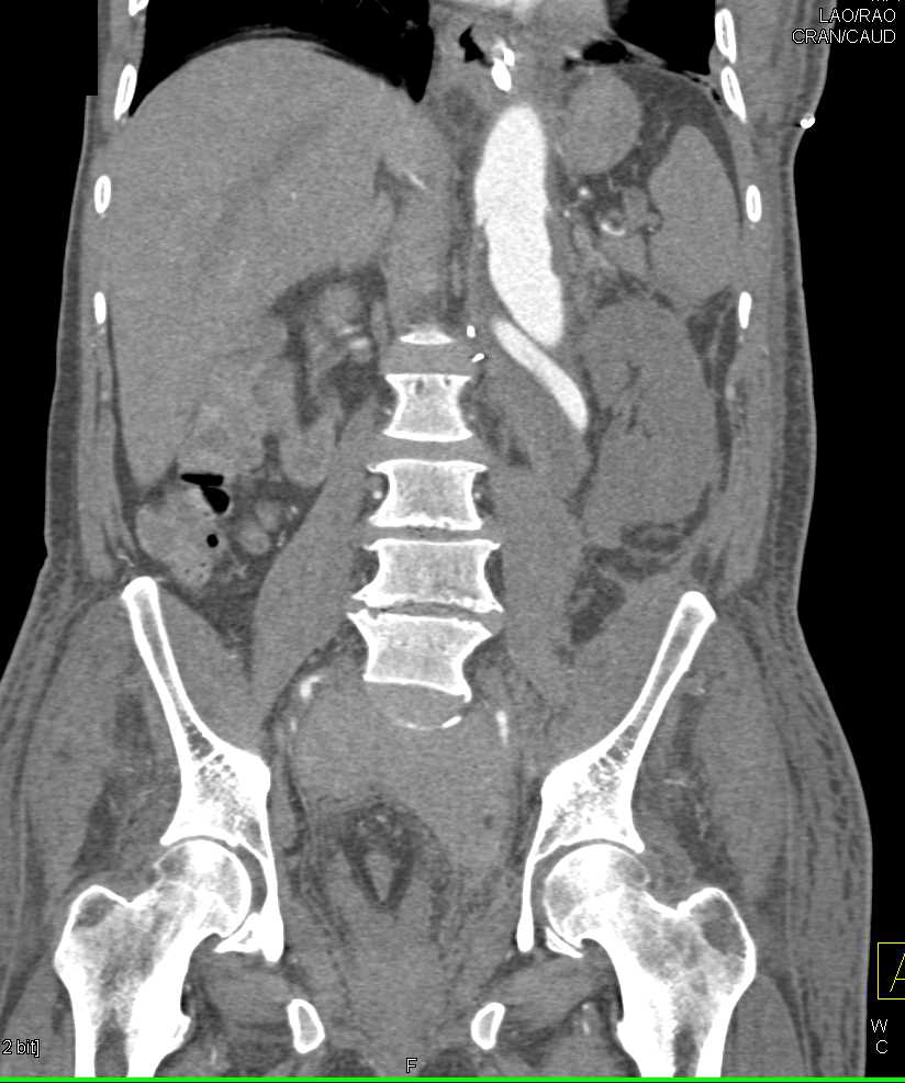 Infarcted Left Kidney with Abdominal Aortic Aneurysm (AAA) - CTisus CT Scan