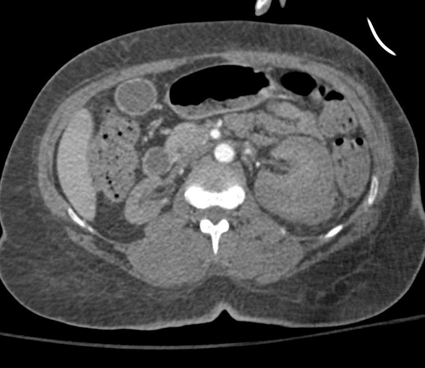 Page Kidney Left Kidney - CTisus CT Scan