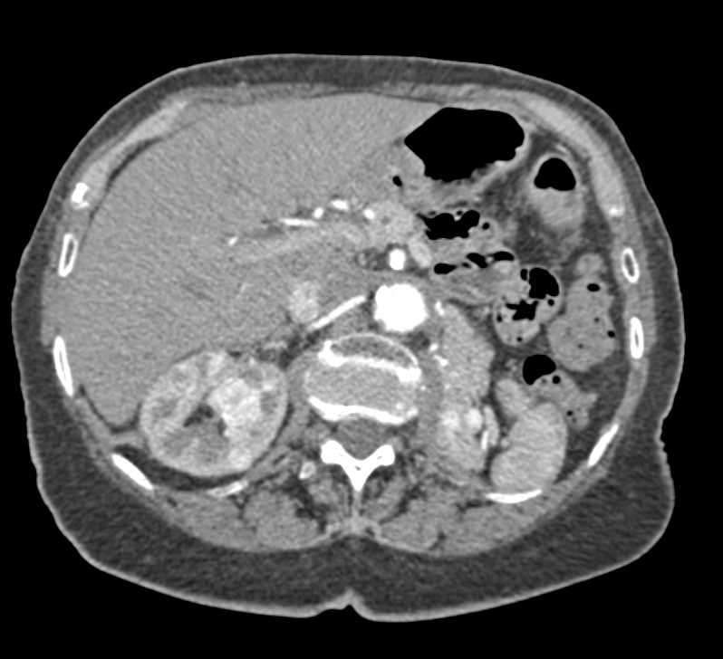 Recurrent Renal Cell Carcinoma with Local Recurrence and Contralateral Metastases - CTisus CT Scan