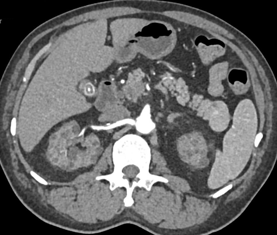 End Stage Renal Disease (ESRD) with Multiple Small Renal Cysts - CTisus CT Scan