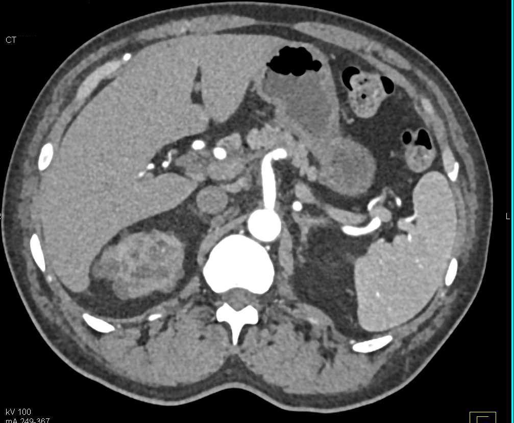 End Stage Renal Disease (ESRD) with Multiple Small Renal Cysts - CTisus CT Scan