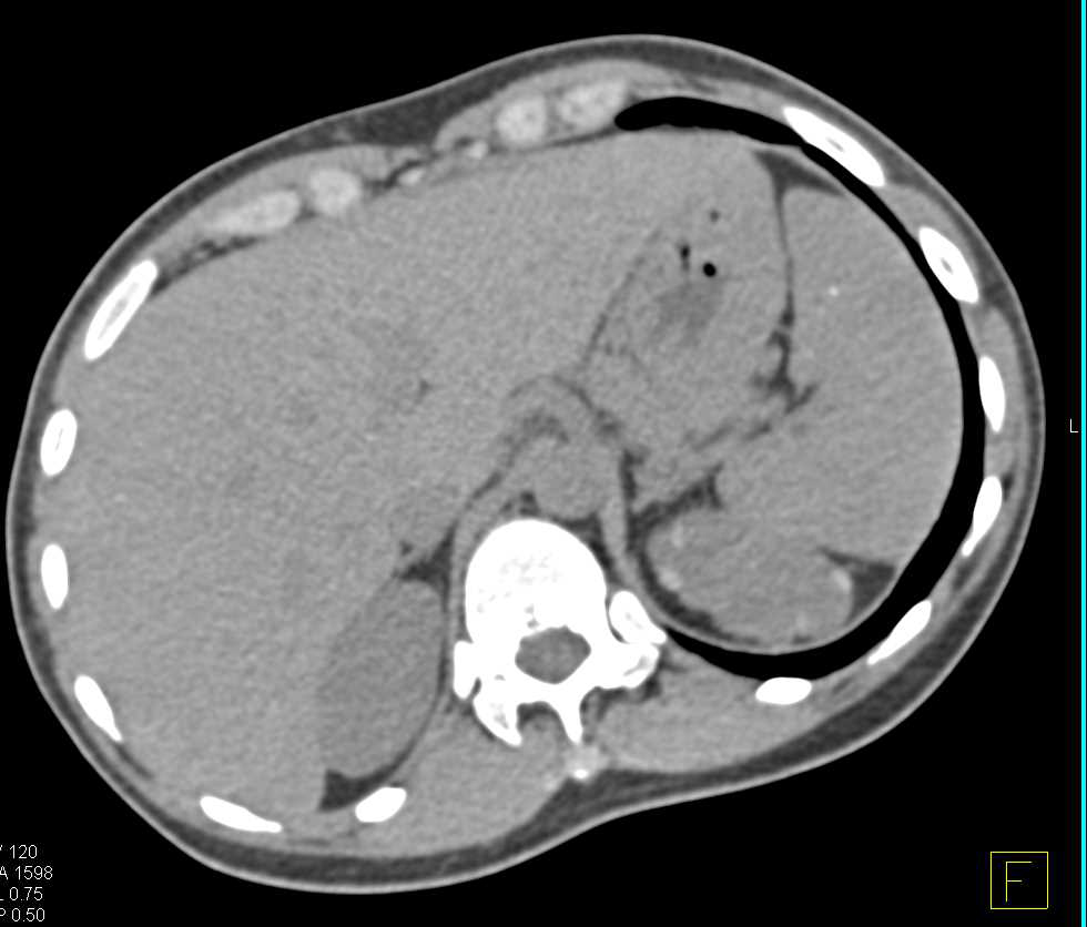 Multiple High Density Renal Cysts Left Kidney - CTisus CT Scan