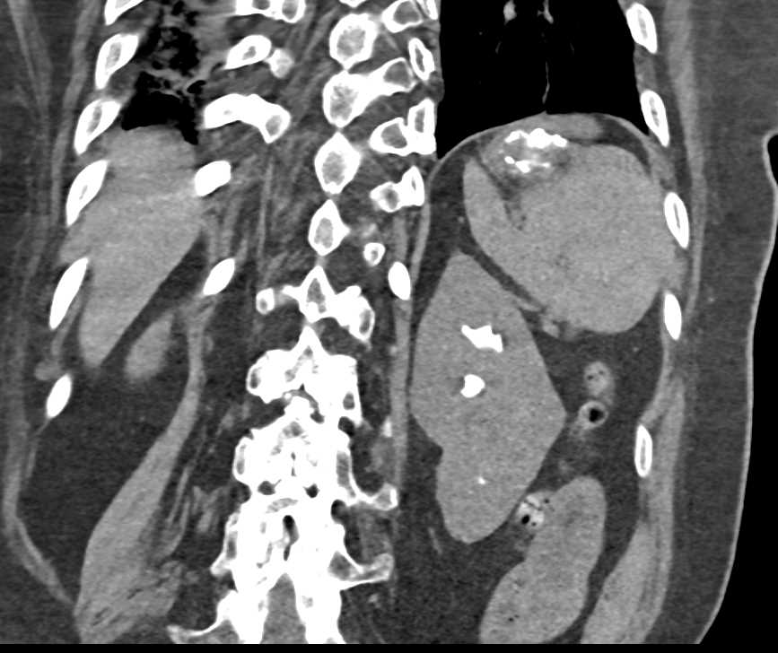 Staghorn Calculi Left Kidney - CTisus CT Scan