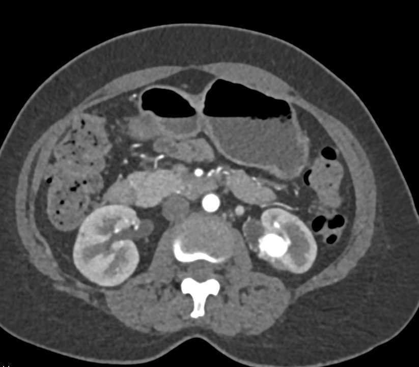Arteriovenous Malformation (AVM) Left Kidney - CTisus CT Scan