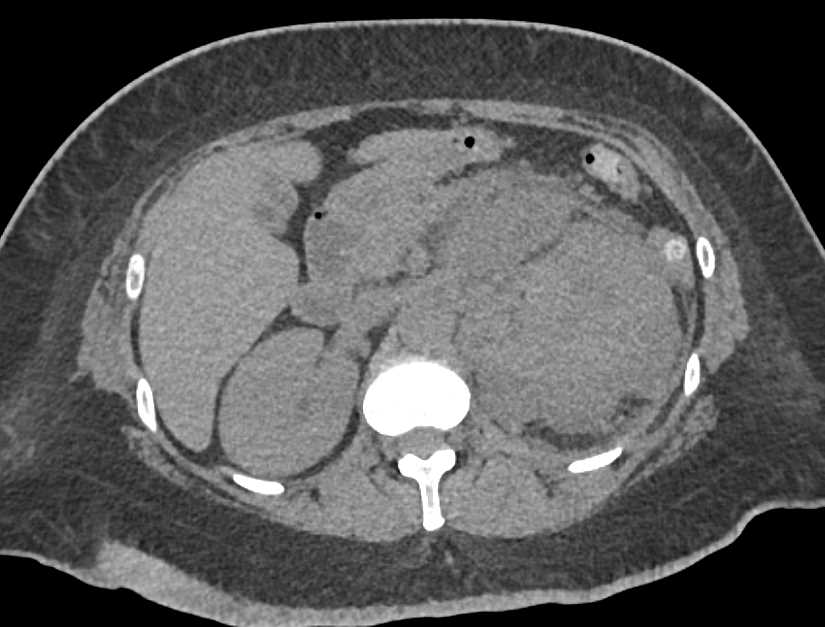 Subcapsular Hematomas Left Kidney Following Trauma - CTisus CT Scan