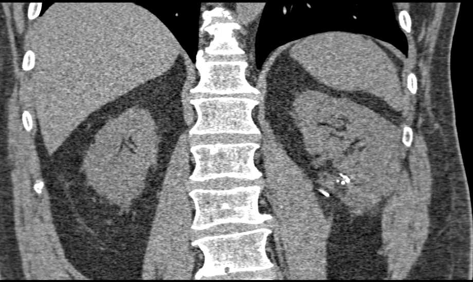 Renal Artery Pseudoaneurysm Near Partial Nephrectomy Site - CTisus CT Scan