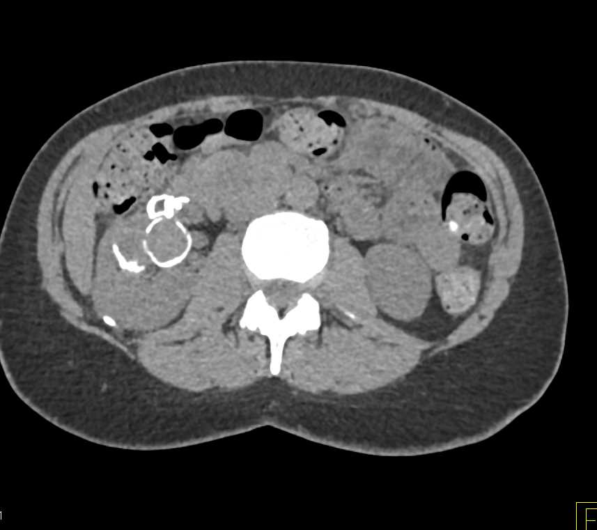 Complex Cysts Right Kidney with Calcifications - CTisus CT Scan