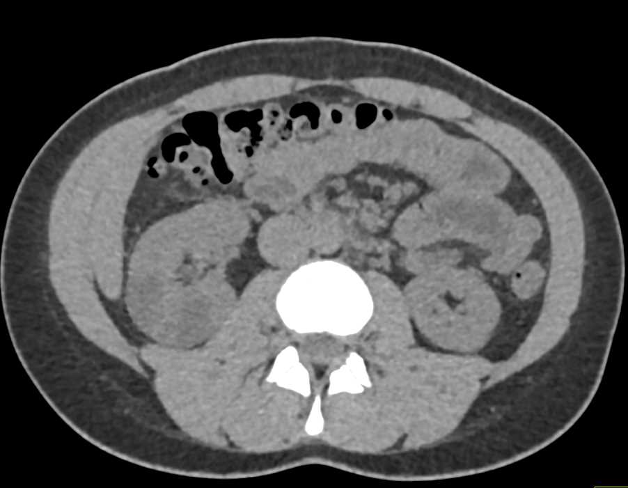 Multilocular Cysts Right Kidney - CTisus CT Scan