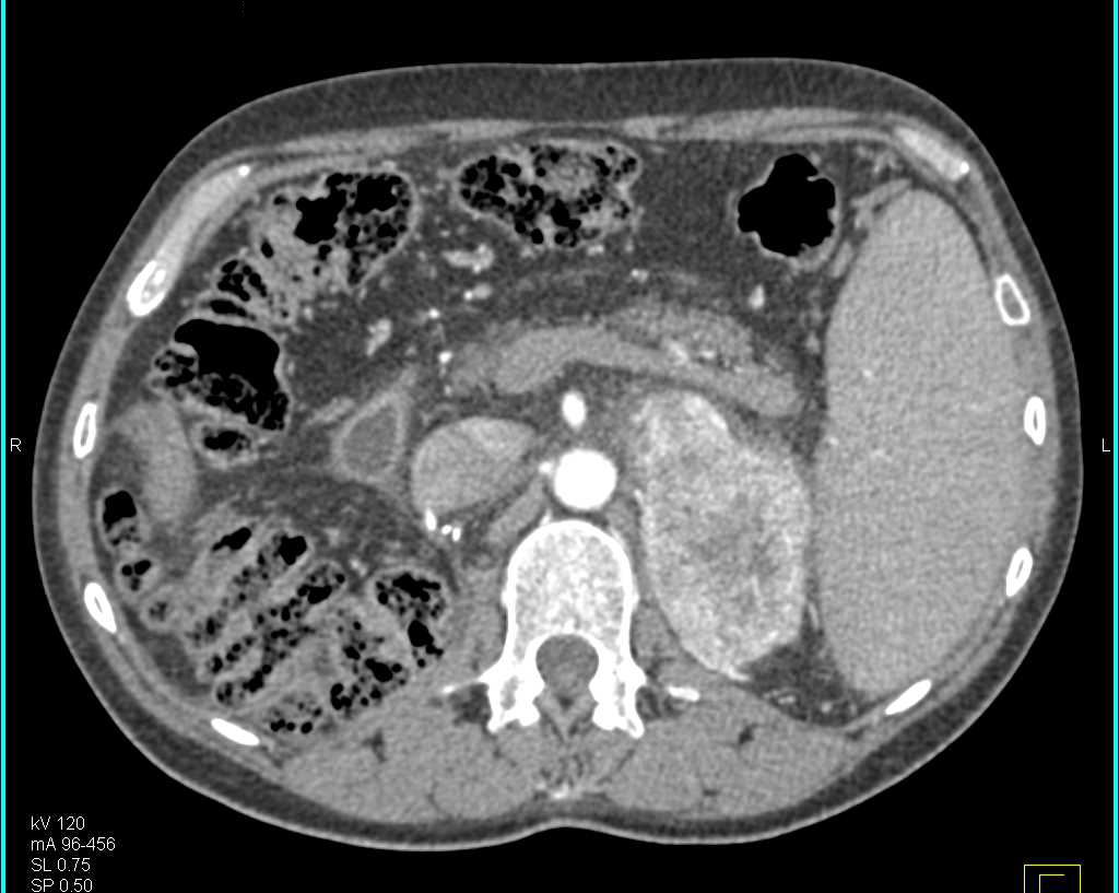Metastatic Renal Cell Carcinoma to the Left Adrenal Gland - CTisus CT Scan