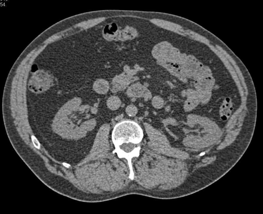 Pseudoaneurysm as a Consequence of Partial Left Nephrectomy - CTisus CT Scan