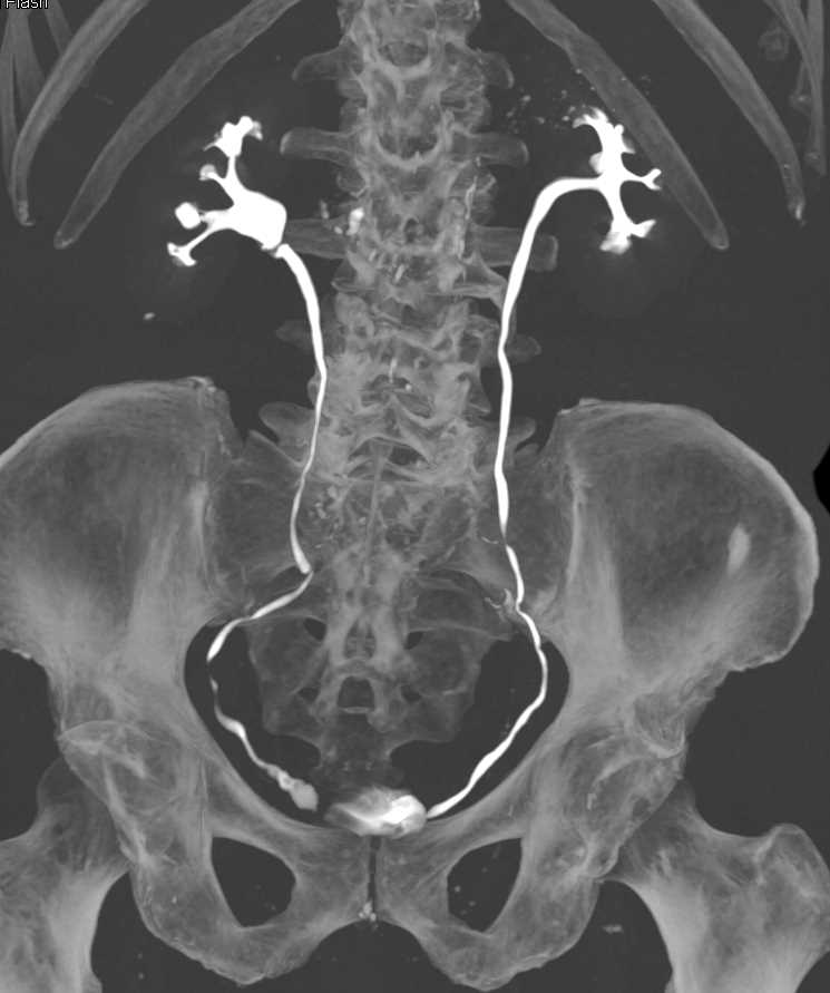 Multiple Calculi in the Distal Right Ureter - CTisus CT Scan