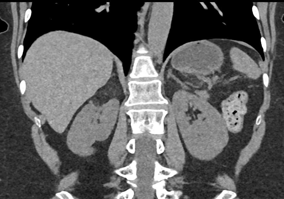Right Renal Angiomyolipoma - CTisus CT Scan