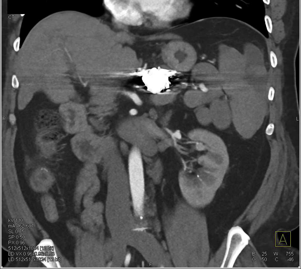 1cm Aneurysm Left Renal Artery - CTisus CT Scan