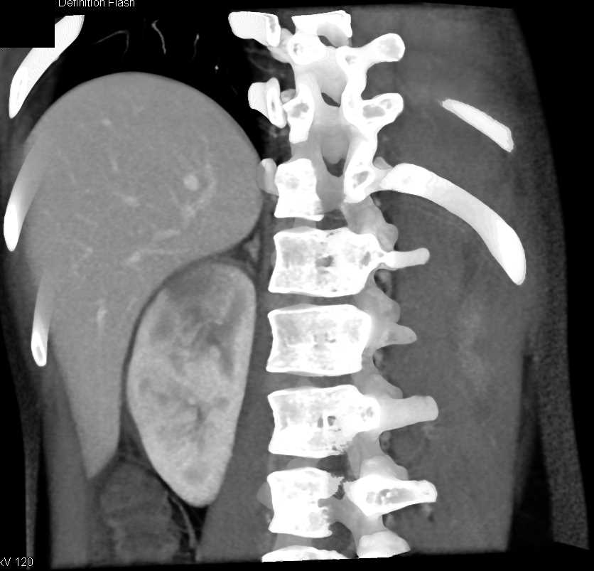 Acute Pyeonephritis Right Kidney - CTisus CT Scan