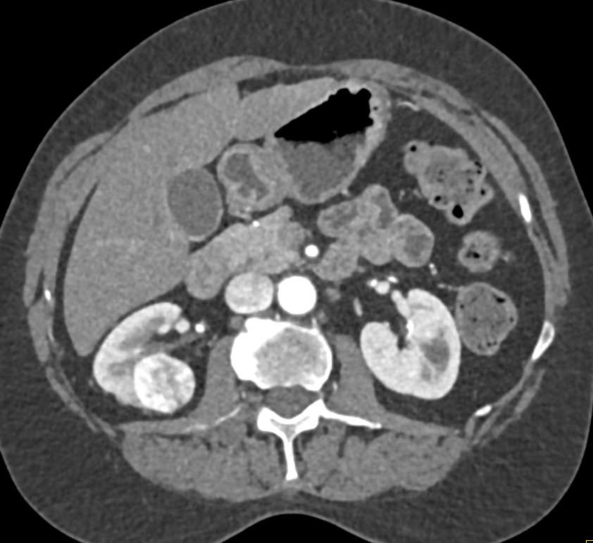 Clear Cell Renal Cell Carcinoma (CCRCC) Simulates an Oncocytoma - CTisus CT Scan