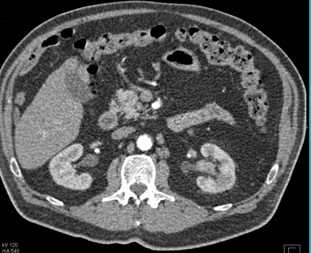 Transitional Cell Carcinoma Left Kidney - CTisus CT Scan