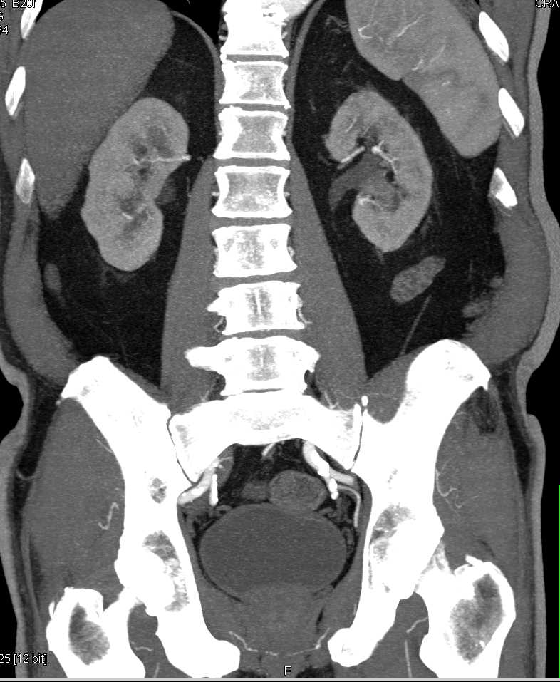 Transitional Cell Carcinoma Left Kidney - CTisus CT Scan