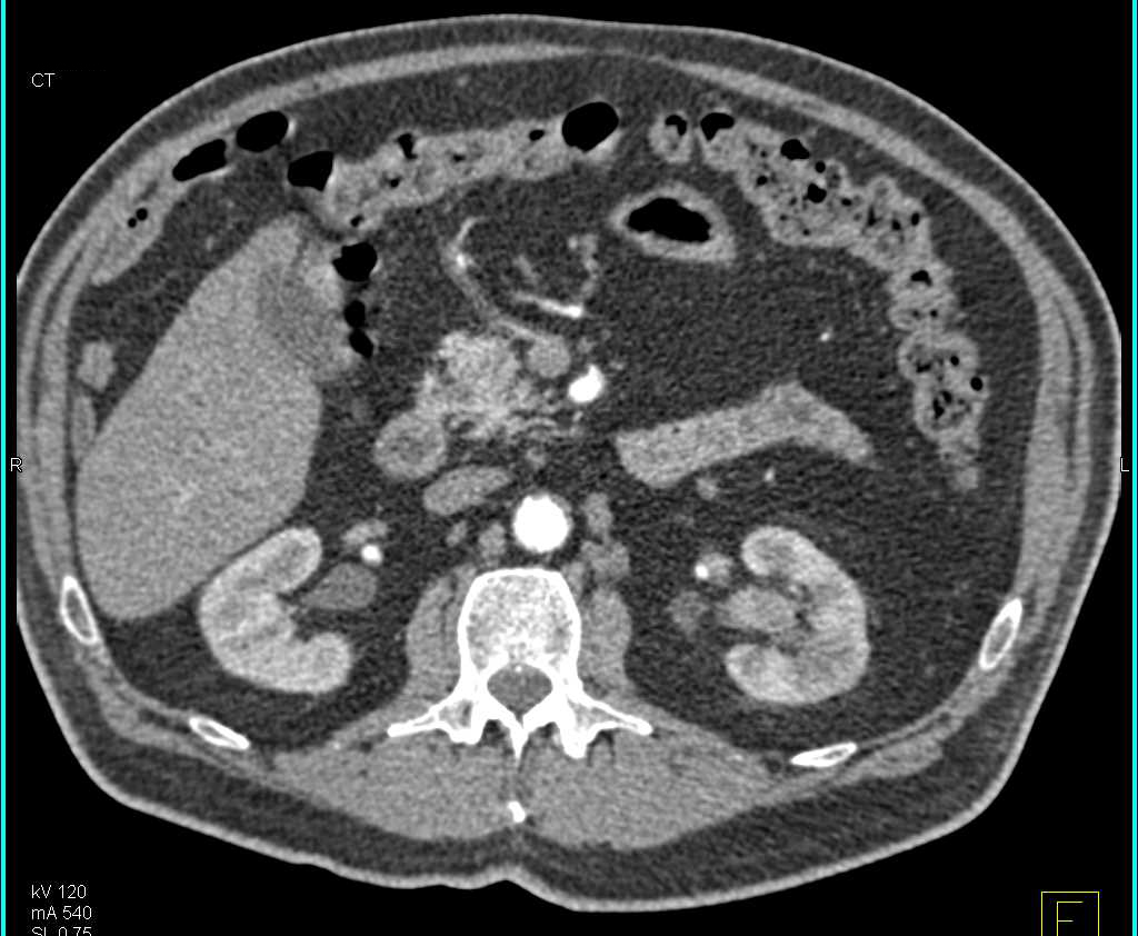 Transitional Cell Carcinoma Left Kidney - CTisus CT Scan