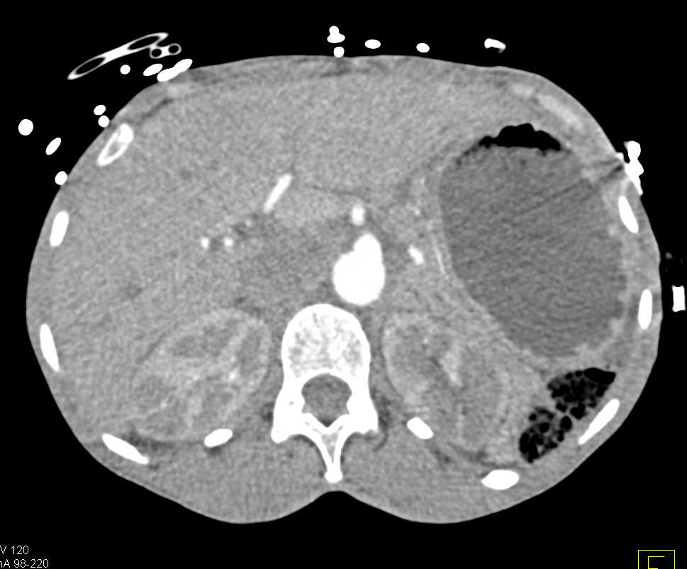 Acute Pyelonephritis - CTisus CT Scan
