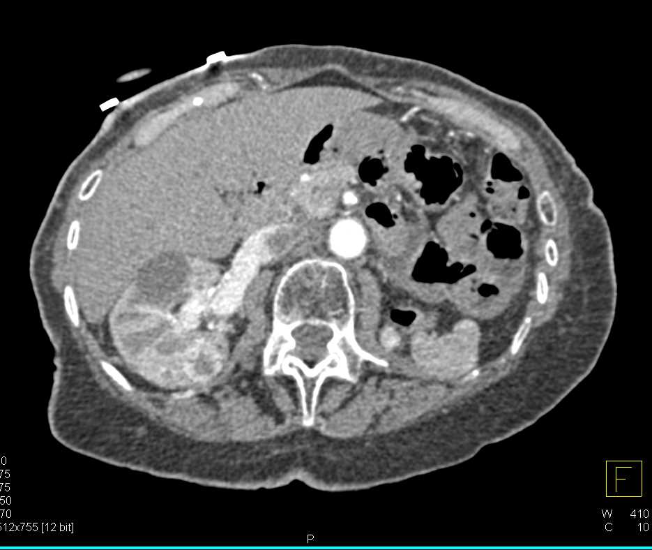 Renal Cell Carcinoma with Lung Metastases and Contralateral Kidney Metastases - CTisus CT Scan