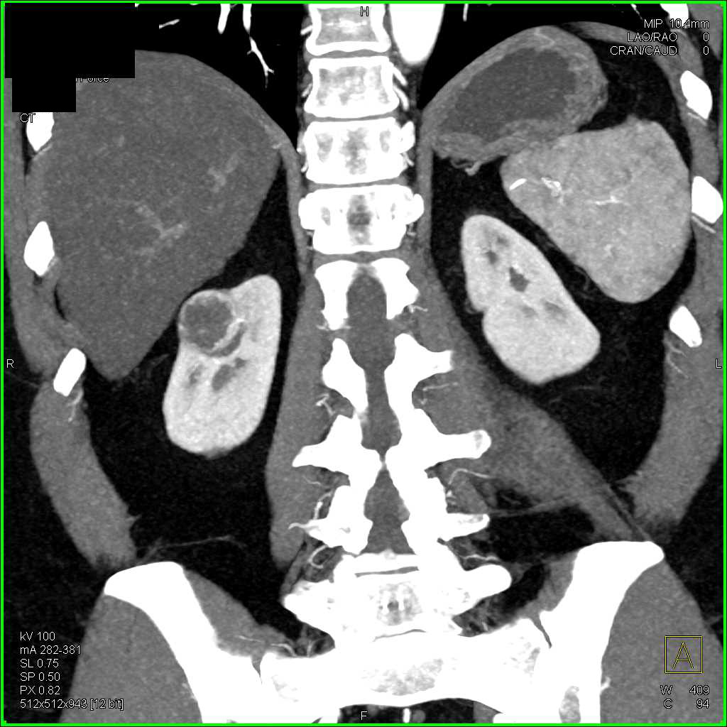 Cystic Right Renal Cell Carcinoma - CTisus CT Scan