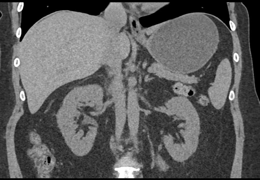 Papillary Renal Cell Carcinoma - CTisus CT Scan