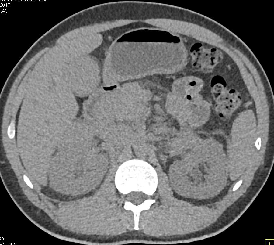 Lymphoma Involving the Porta Hepatis as well as the Right Kidney - CTisus CT Scan