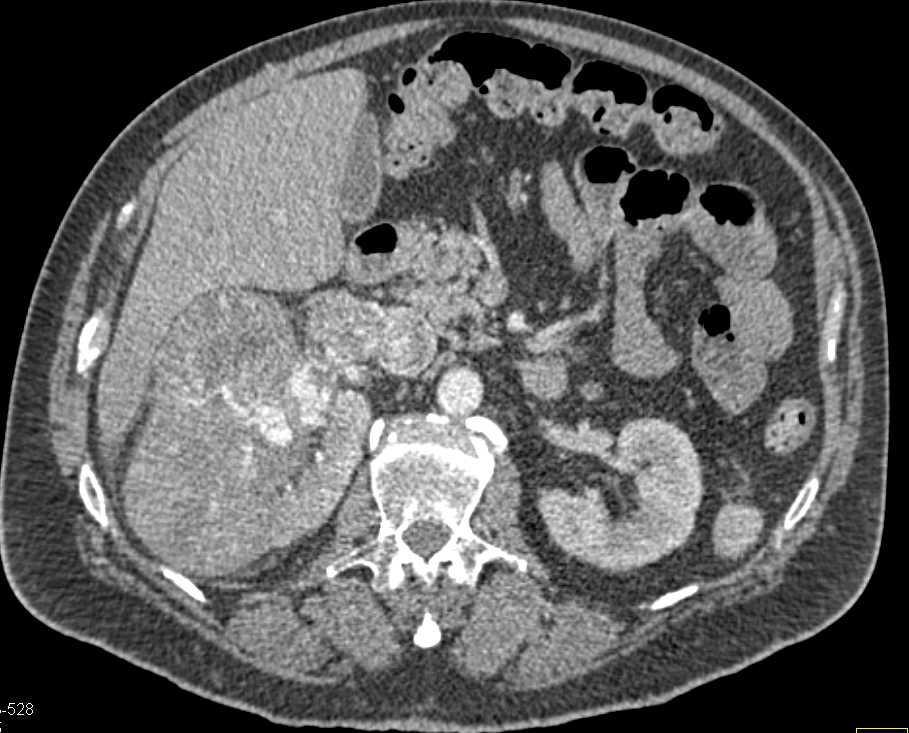 Clear Cell Renal Cell Carcinoma (CCRCC) Invades the Renal Vein and Inferior Vena Cava (IVC) - CTisus CT Scan