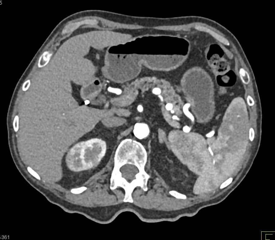 Acute Pyelonephritis Right Kidney and Bladder Cancer - CTisus CT Scan