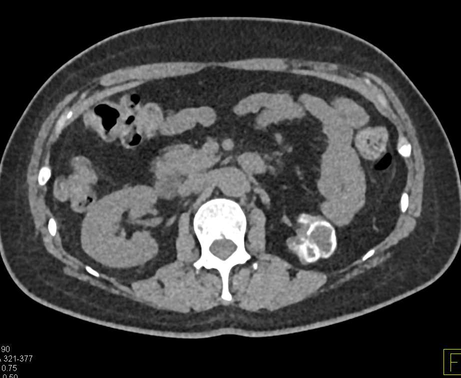 Tuberculosis (TB) of the Left Kidney - CTisus CT Scan