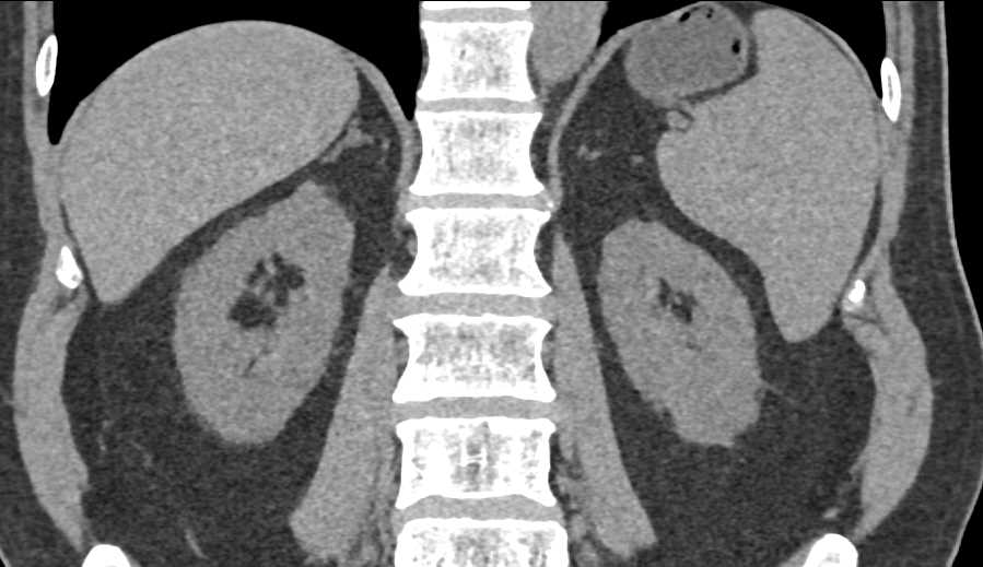 5mm Renal Cell Carcinoma Upper Pole Right Kidney - CTisus CT Scan