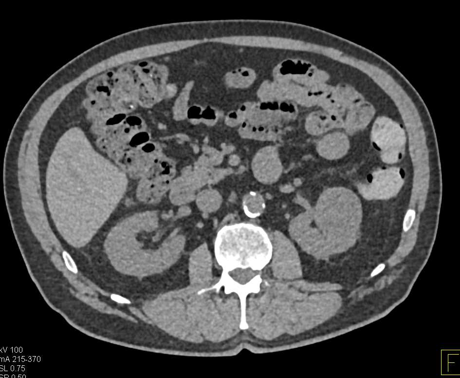 Renal Cell Carcinoma Left Kidney - CTisus CT Scan