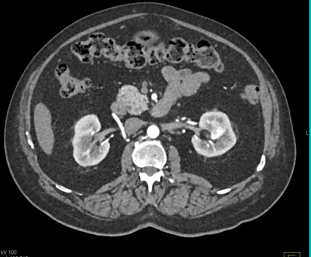 Renal cell carcinoma of the Left Kidney - CTisus CT Scan