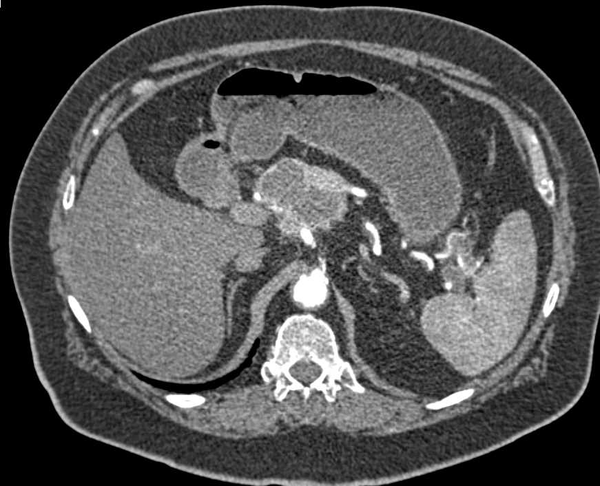 Metastatic Renal Cell Carcinoma to the Pancreas - CTisus CT Scan