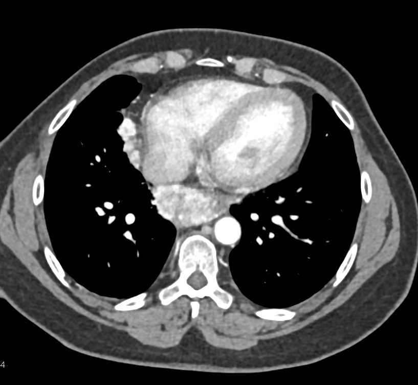Metastatic Renal Cell Carcinoma to the Mediastinum - CTisus CT Scan