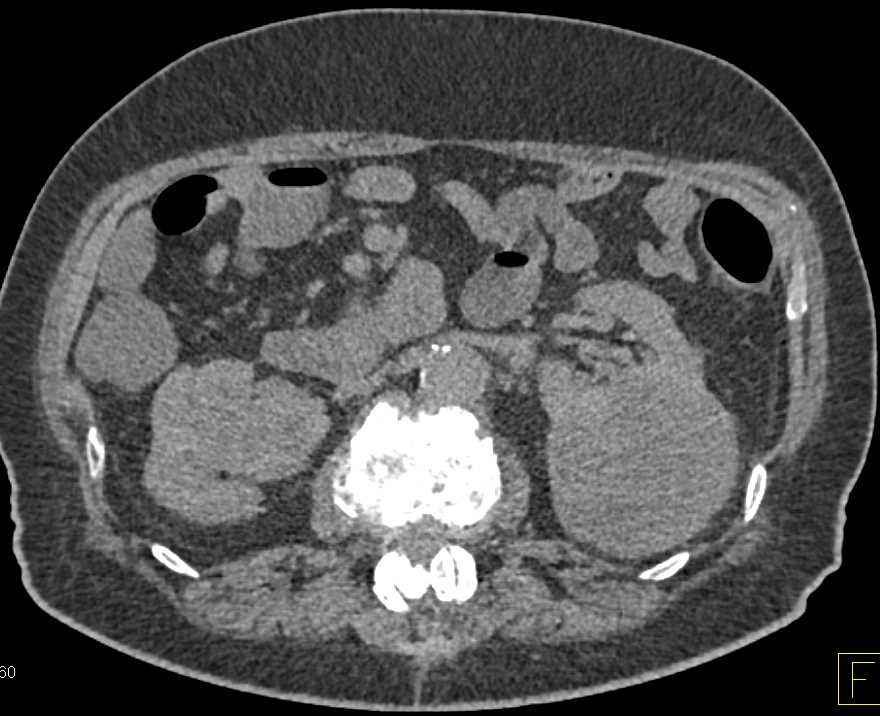 Bilateral Renal Cell Carcinomas and Pulmonary Embolism (PE) - CTisus CT Scan