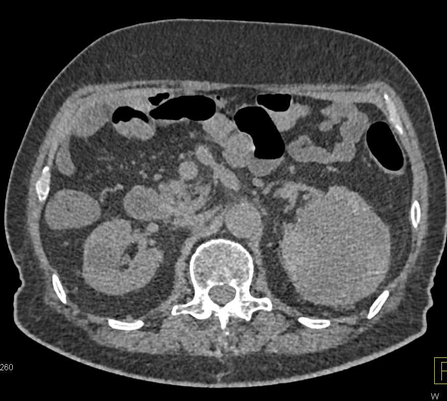 Bilateral Renal Cell Carcinomas - CTisus CT Scan