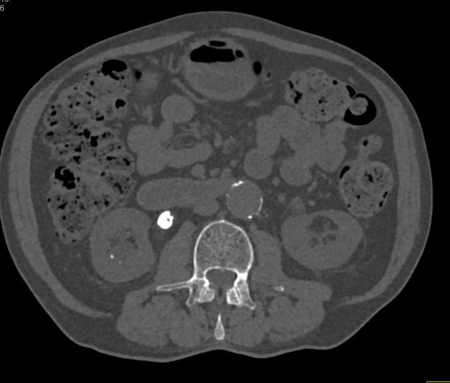 Obstructing Stone in Proximal Right Ureter - CTisus CT Scan
