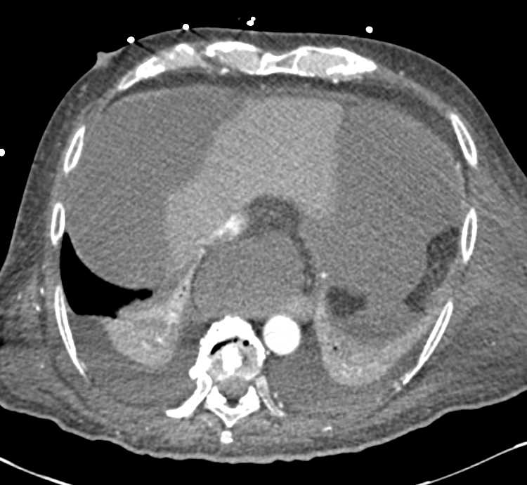 Extensive Vascular Disease Especially Involving the Renal Arteries - CTisus CT Scan