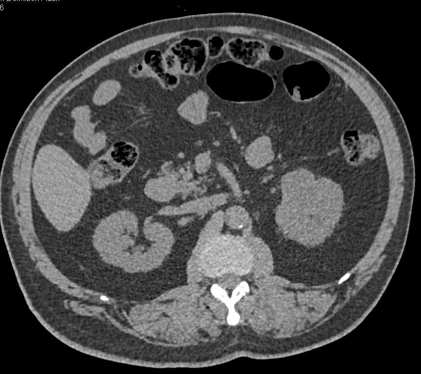 Clear Cell Renal Cell Carcinoma (CCRCC) Left Kidney - CTisus CT Scan