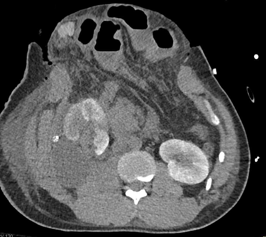 Renal Infarction - CTisus CT Scan