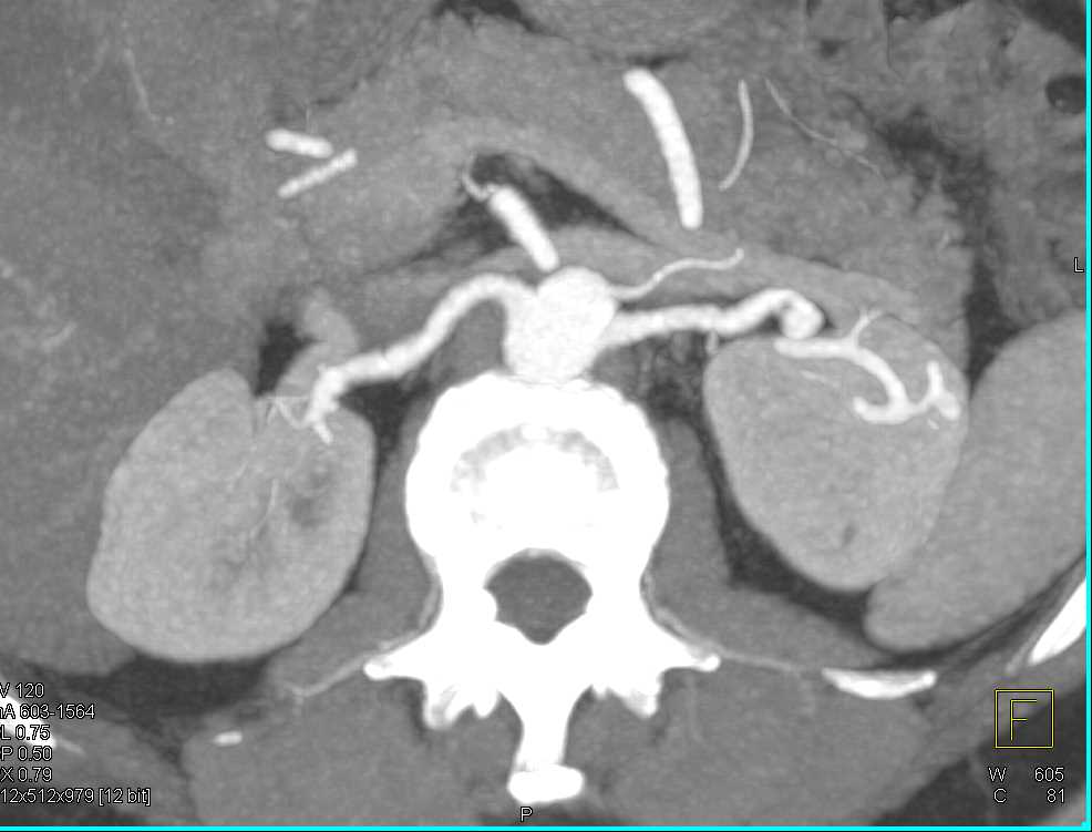 FMD (Fibromuscular Dysplasia) Renal Arteries with Aneurysm Left Renal Artery - CTisus CT Scan