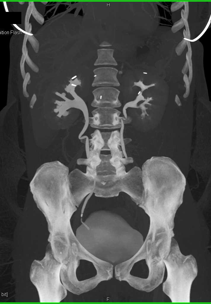 Transitional Cell Carcinoma (TCC) Lower Pole Left Kidney with Distortion of the Calyceas - CTisus CT Scan